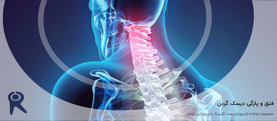 بیرون زدگی دیسک گردن (فتق دیسک گردن) |علل، علائم، انواع و درمان
