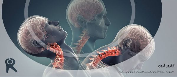آرتروز گردن | علل، علائم، تشخیص، پیشگیری و روشهای درمان