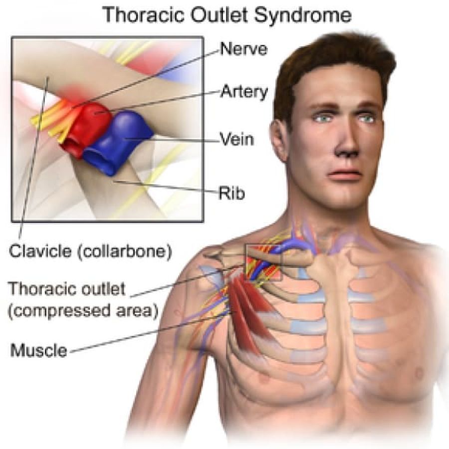 Thoracic Outlet Syndrome (TOS)