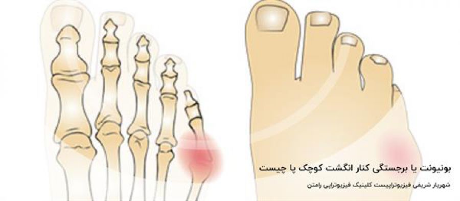 بونیونت یا برجستگی کنار انگشت کوچک پا چیست؟ + علائم و درمان