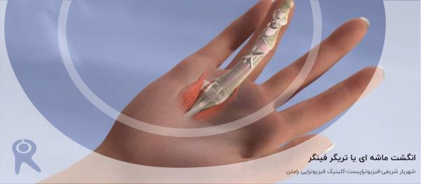 انگشت ماشه ای (تریگر فینگر) | علل، علائم، تشخیص و روشهای درمان