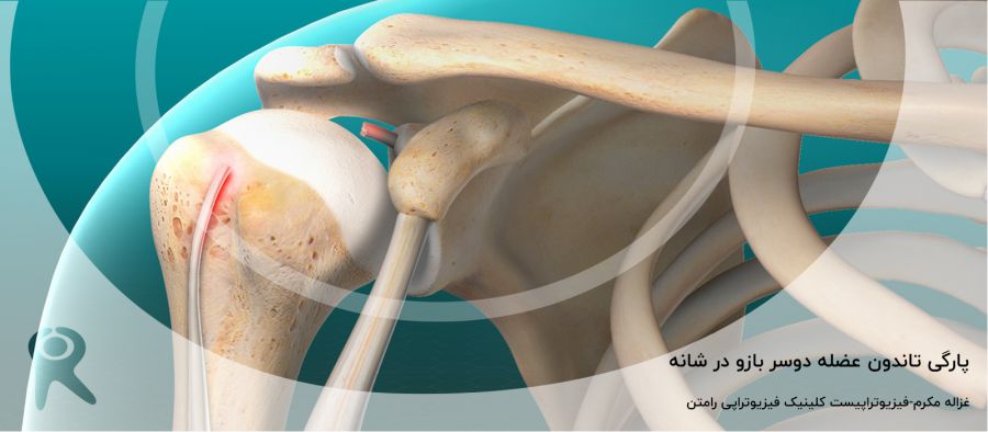 پارگی تاندون عضله دوسر بازو در شانه | علائم و تشخیص + درمان