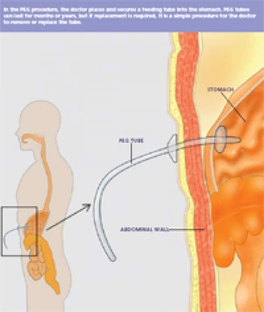 Percutaneous Endoscopic Gastrotomy