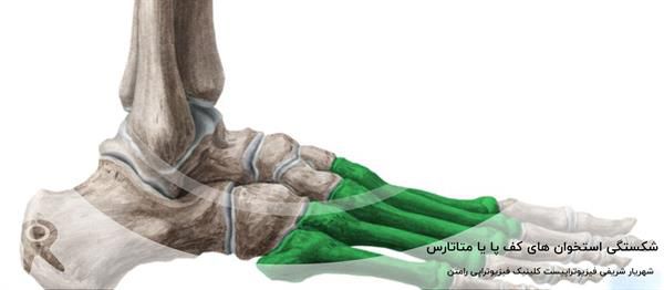 شکستگی استخوانهای کف پا (متاتارس) | علائم، انواع + درمان و ورزش