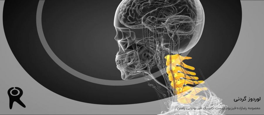 لوردوز گردنی | علل، علائم و درمان گودی گردن با فیزیوتراپی و ورزش