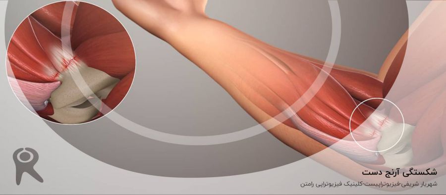 شکستگی آرنج دست | علل، علائم، تشخیص، انواع و روشهای درمان